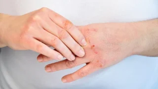 nhiễm trùng ở bệnh nhân ung thư