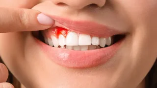 bệnh chảy máu ở miệng