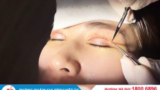 cách cắt chỉ vết thương