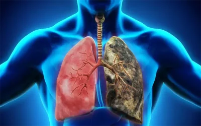dấu hiệu của ung thư phổi