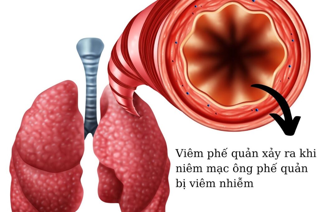 Các nguyên nhân gây bệnh viêm phế quản