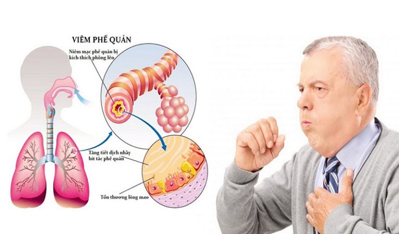 Viêm phế quản là bệnh gì?