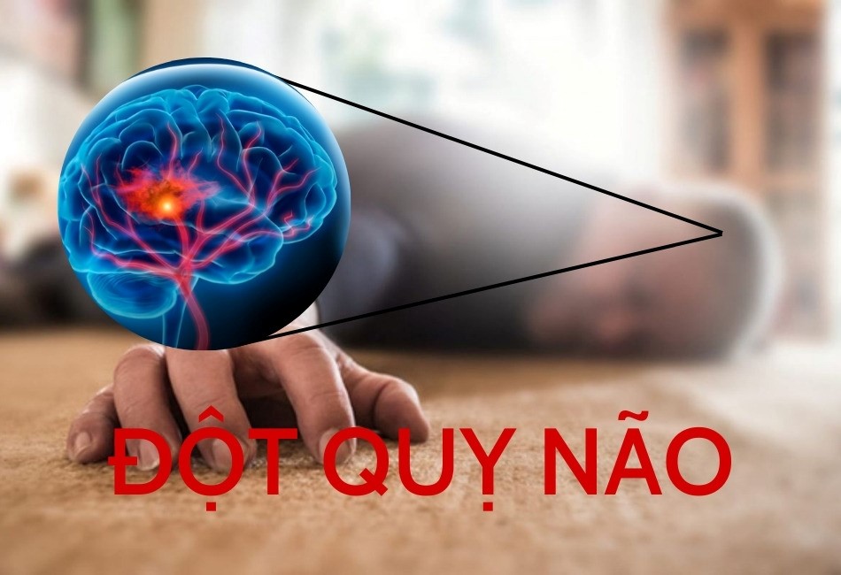 cách sơ cứu đột quỵ