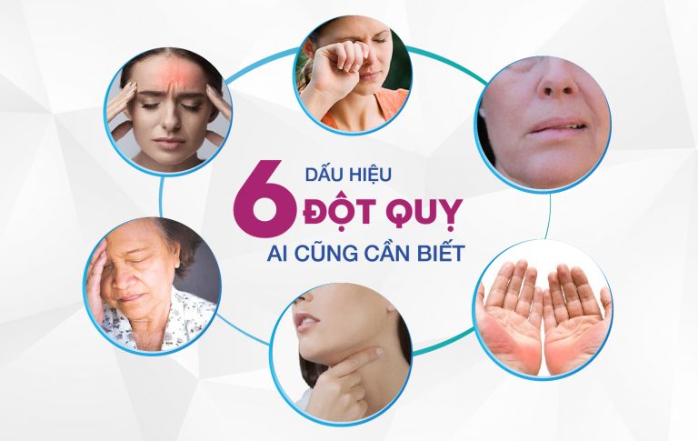 Dấu hiệu nhận biết bệnh đột quỵ