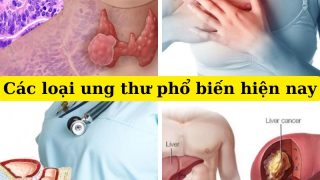 các loại ung thư phổ biến hiện nay