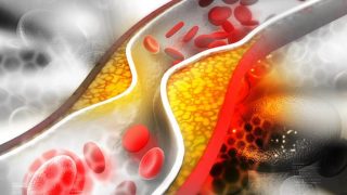 Chỉ số cholesterol cao kiêng ăn gì