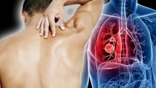 tầm soát ung thư phổi