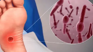 vết thương hở uốn ván