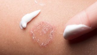 thuốc trị lác đồng tiền