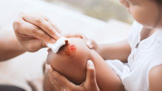 Cách rửa vết thương hở tại nhà giúp ngăn ngừa nhiễm trùng.